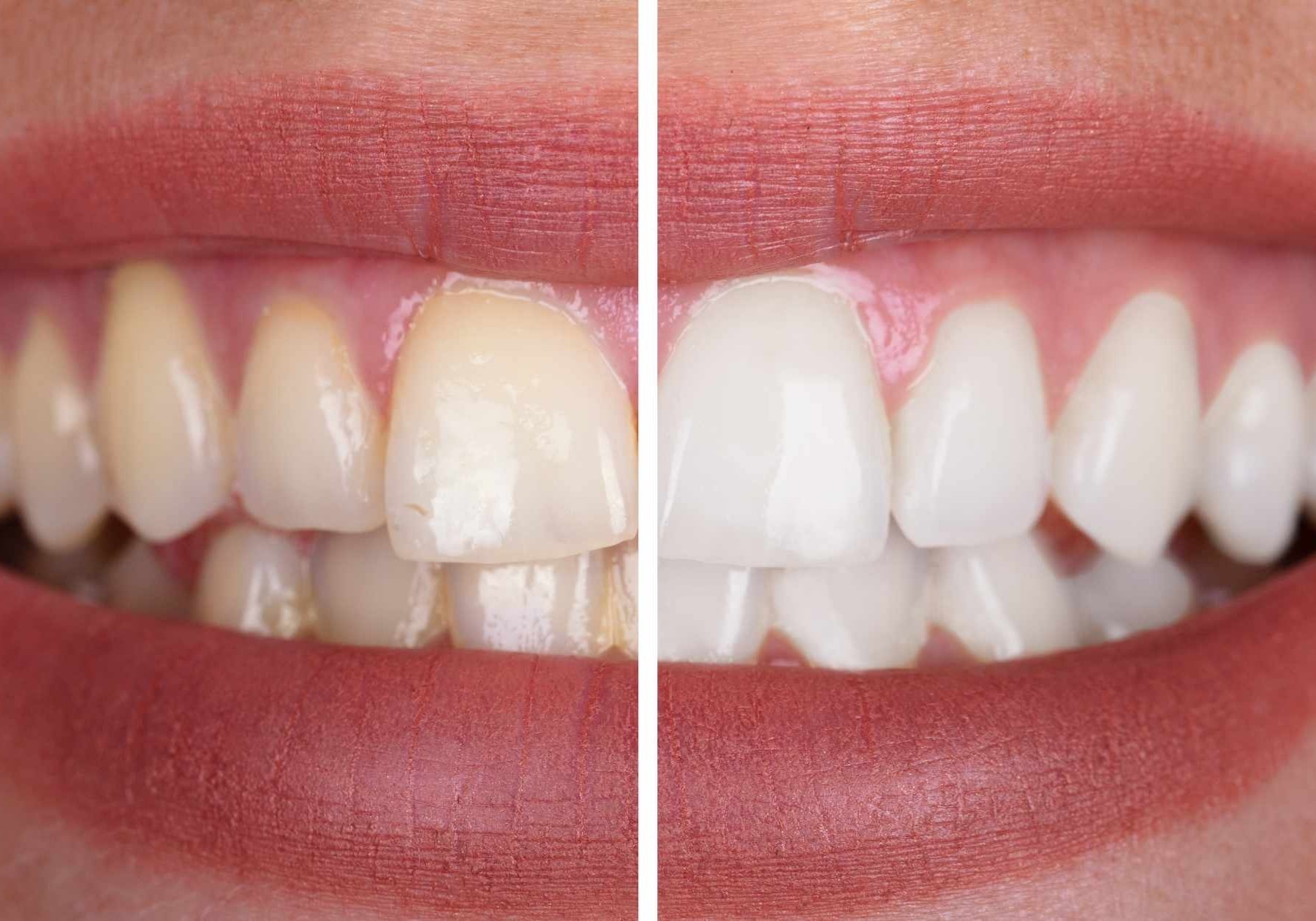 Teeth Whitening Before